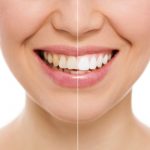 professional zoom teeth whitening